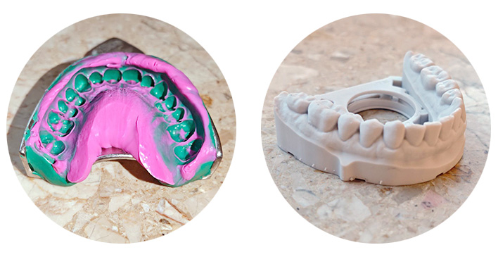 Klassischer Abdruck mit Löffel und Abformmasse